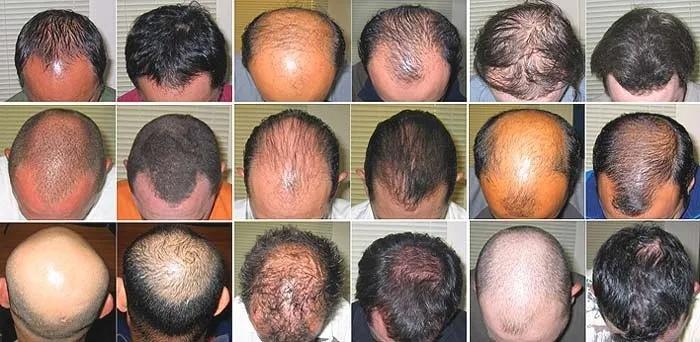 provillus-for-men-before-and-after