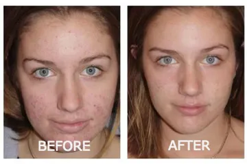 Skin-Exfoliator-before-after
