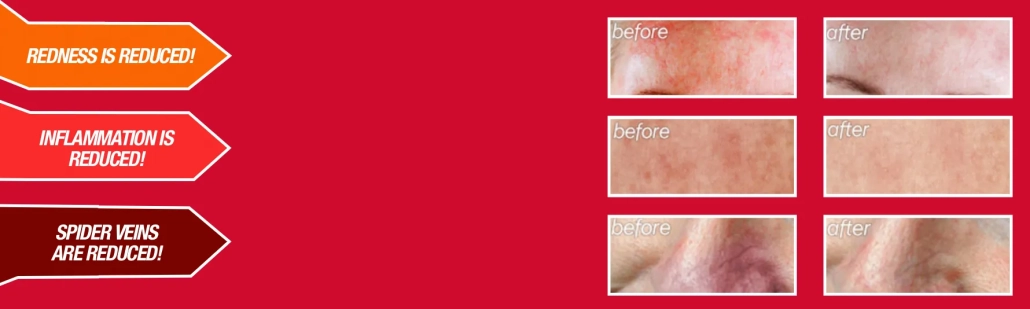 rosacea-relief-serum-before-and-after