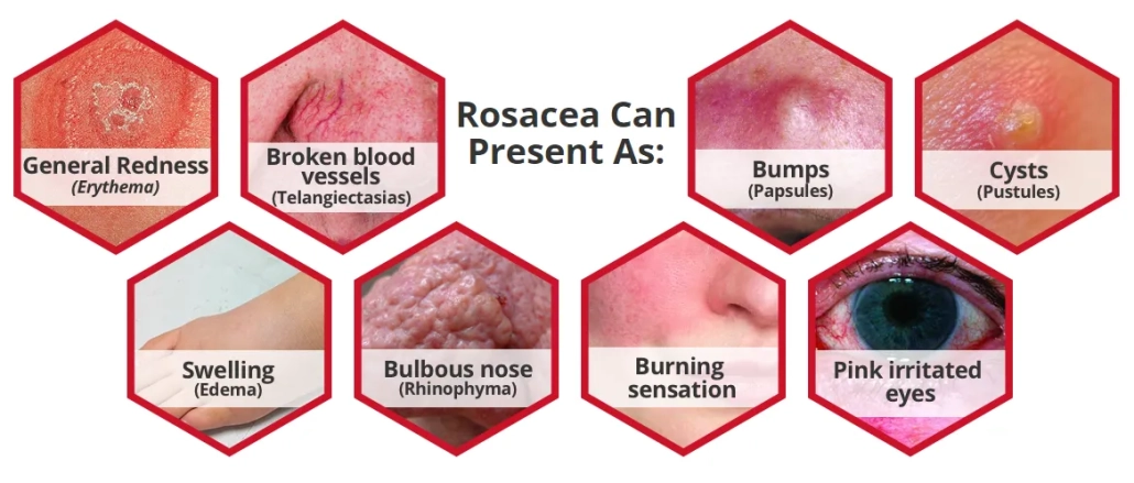 rosacea-relief-serum-rosacea-symptoms