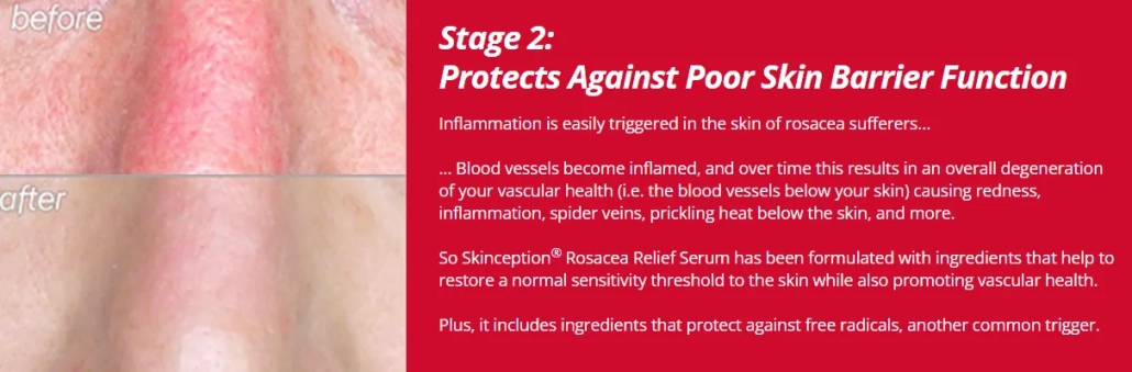 rosacea-relief-serum-stage2-blood-vessels-become-inflamed