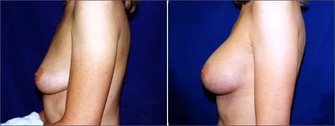 BEFORE-AND-AFTER-BREAST-ACTIVES