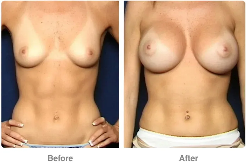 breast-actives-before-after-1