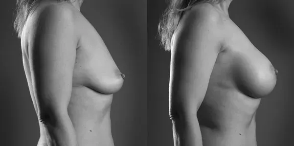 breast-actives-before-and-after-1