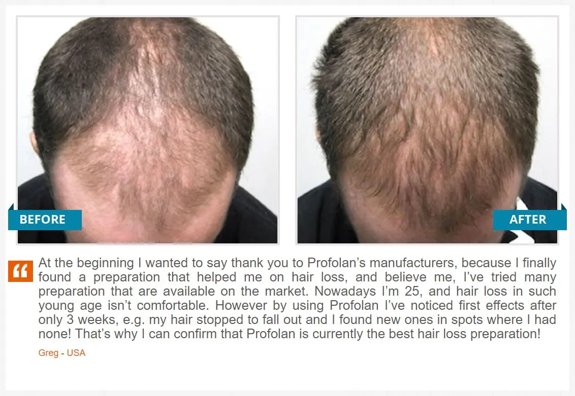 Profolan customer reviews and testimonials before and after